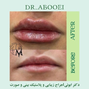 تزریق-فیلر-14