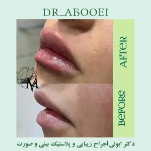 تزریق-فیلر-15
