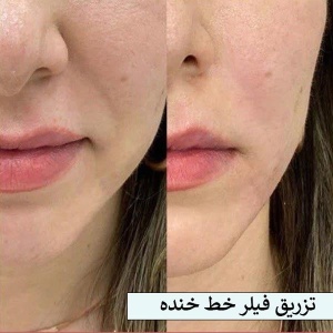 تزریق-فیلر-16