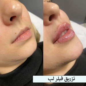 تزریق-فیلر-17