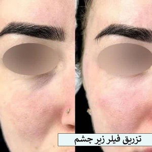 تزریق-فیلر-18