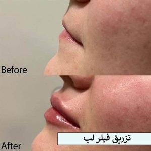 تزریق-فیلر-20