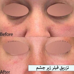 تزریق-فیلر-21