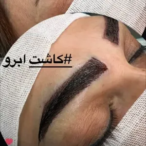 کاشت-مو-و-ابرو-10