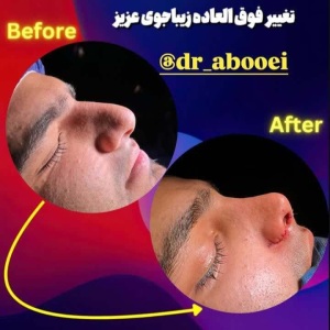 جراحی-بینی-101