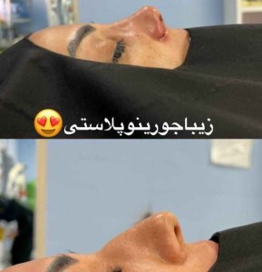 جراحی-بینی-103