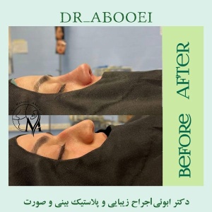 جراحی-بینی-92
