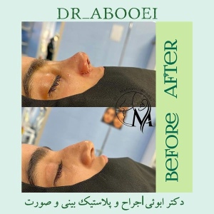 جراحی-بینی-95
