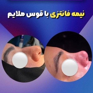 جراحی-بینی-96