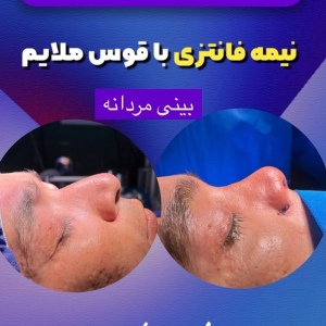 جراحی-بینی-97