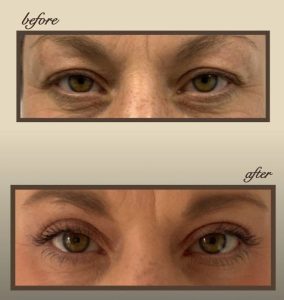 بلفاروپلاستی یا جراحی پلک در رفسنجان _ دکتر محسن ابویی