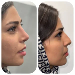 نمونه کار بهترین جراح بینی رفسنجان _ دکتر محسن ابویی