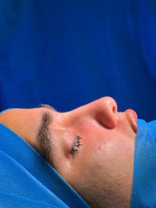 عمل بینی گوشتی در کرمان _ دکتر محسن ابویی