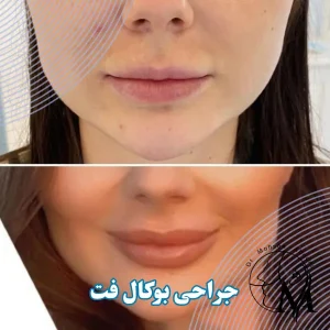 عمل بوکال فت در رفسنجان _ دکتر محسن ابویی