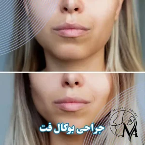 جراحی بوکال فت در کرمان _ دکتر محسن ابویی