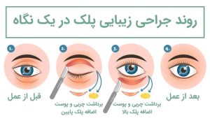 عمل بلفاروپلاستی در رفسنجان _ دکتر محسن ابویی