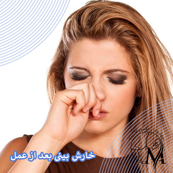 خارش بینی بعد از عمل _ دکتر محسن ابوی