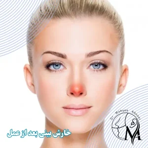 خارش بینی بعد از عمل _ دکتر محسن ابویی