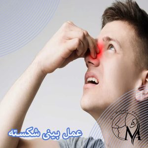 جراحی بینی شکسته در رفسنجان _ دکتر محسن ابویی