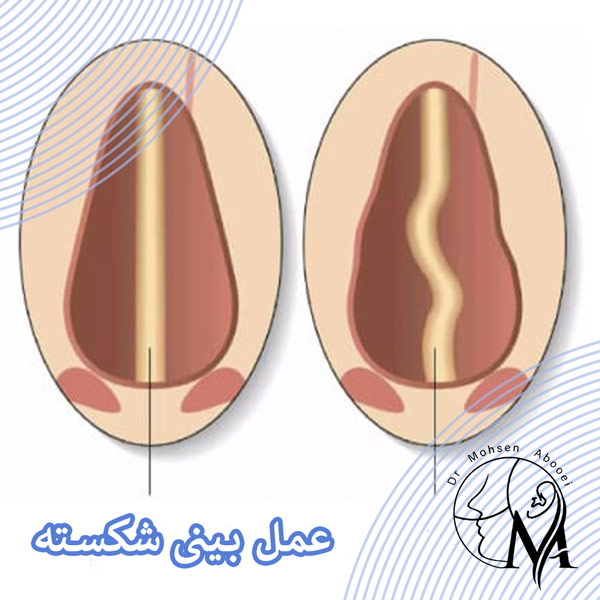 عمل بینی شکسته در رفسنجان _ دکتر محسن ابویی