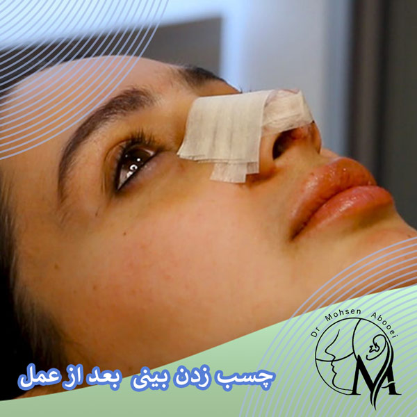 چسب زدن بینی بعد از عمل _ دکتر محسن ابویی