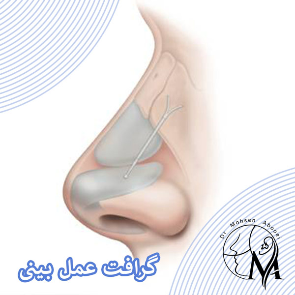 گرافت عمل بینی _ دکتر محسن ابویی